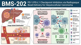BMS-202 PD-1/PD-L1 Checkpoint Inhibition via Radiopaque Bead Delivery for Hepatocellular Carcinoma
